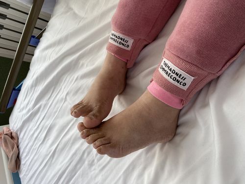 多伦县人民医院儿科成功治愈一名唐氏综合征合并支气管炎患儿