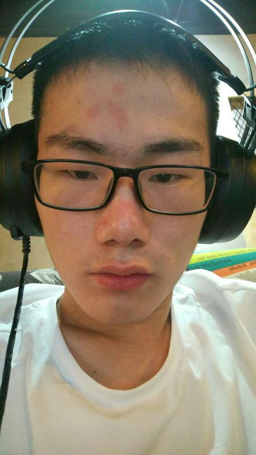 额头上有个红斑 好不了