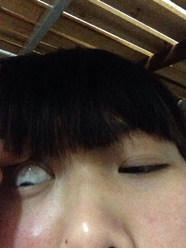 白眼球上方有貌似血块,然后还牵出好多血丝,不痛不痒就是感觉到眼睛累