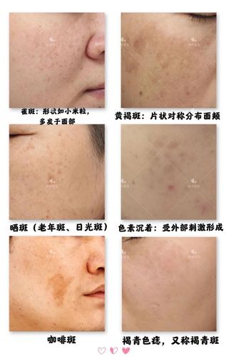 黄褐斑怎样才能彻底去掉|雀斑|长斑|色斑|治疗_网易