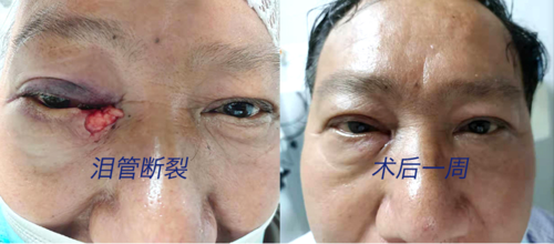 眼角破皮加肿胀 医生半夜为其"排险除爆"修复泪管通道