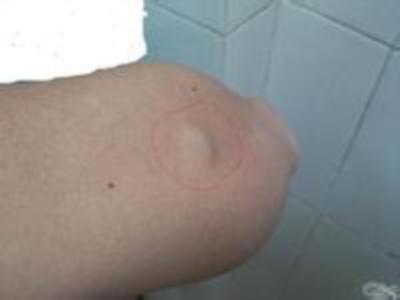 脂肪瘤皮下脂肪瘤和皮下脂肪囊肿的区别