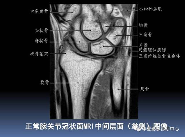 【影像基础】腕关节mri解剖及常见病诊断