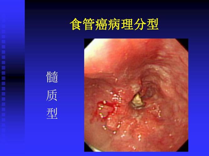 食管癌术后护理ppt