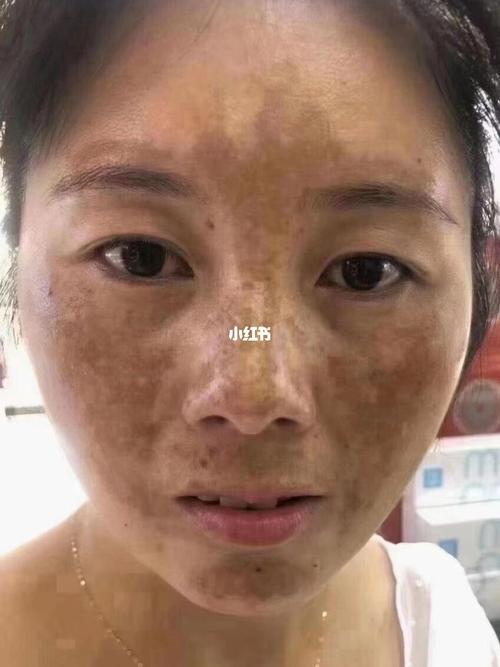 脸都锈成这样了_黄褐斑_美妆_护肤