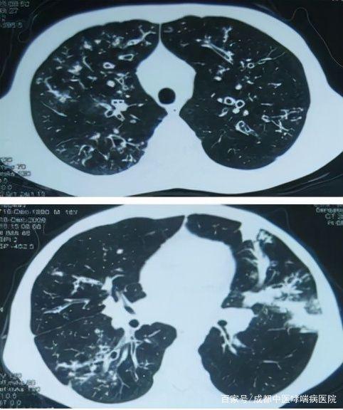 支气管扩张治愈不敢想?错!|咯血|气道|症状|治疗|杵状