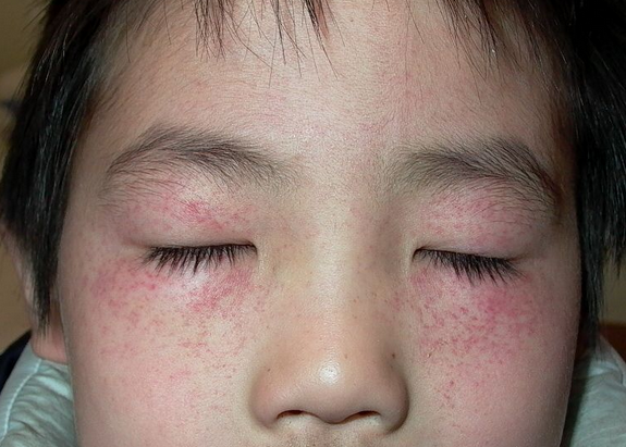 过敏性紫癜会遗传给孩子吗 过敏性紫癜的危害到底有哪些呢