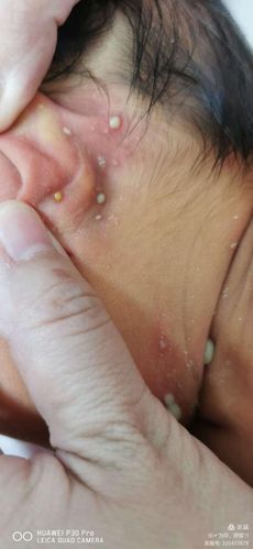 除了湿疹,新生儿还容易得这种可怕的皮肤病