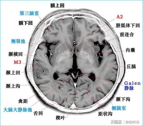 t2wi反相图学标本高清颅脑断层解剖