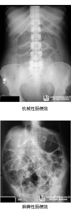 机械性肠梗阻与麻痹性肠梗阻的鉴别诊断?