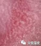 女性假性湿疣与尖锐湿疣辨别图(密集恐惧勿点)