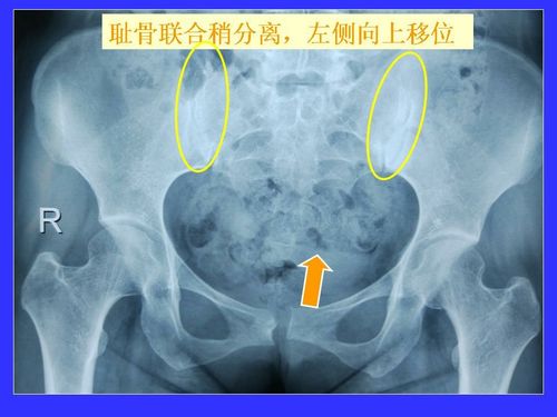 治疗耻骨联合分离