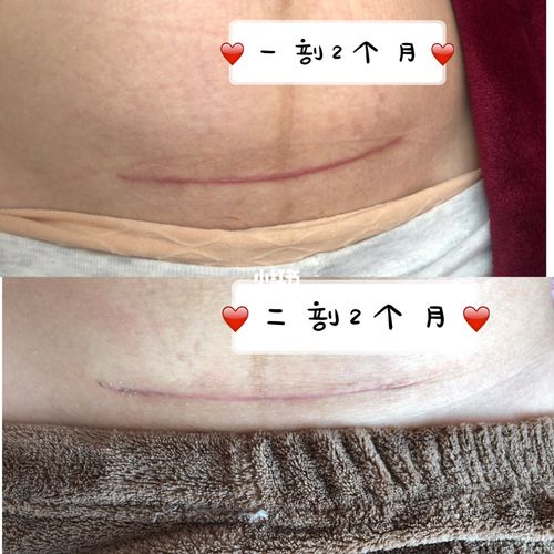 两胎剖腹产疤痕对比图_疤痕_剖腹产_金地玺湾自由行热门攻略_粘性