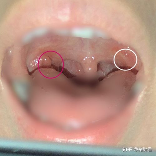记一次扁桃体切除