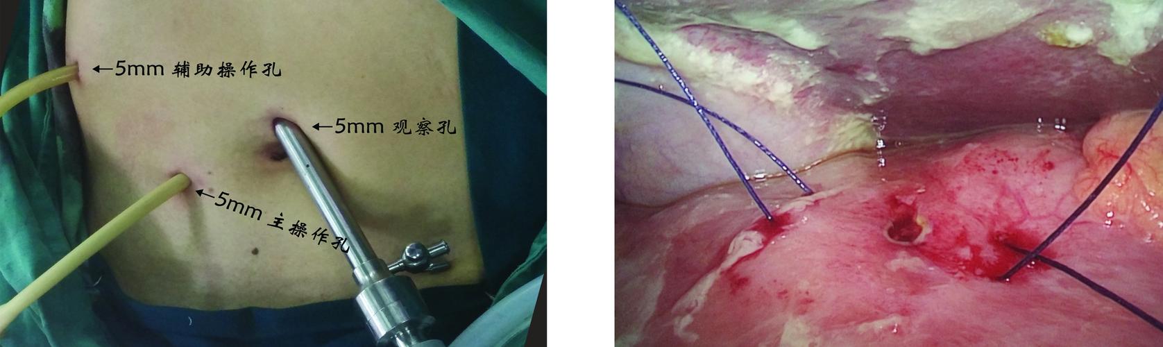 腹腔镜与开腹手术治疗胃十二指肠溃疡穿孔的临床研究
