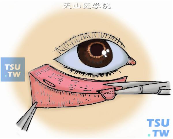 在眶隔中央剪开,脂肪球即自动脱出,或用手指轻压眶下区亦可使脂肪球