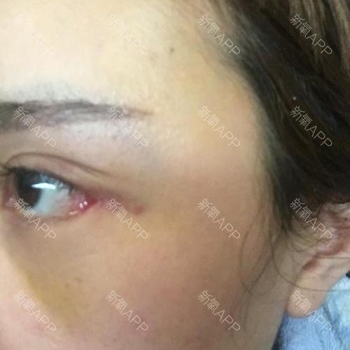 第9天,开的外眼角加下至,我想问这样正常吗,露肉好多,好红