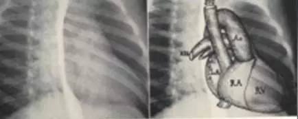 右前斜位片示意图