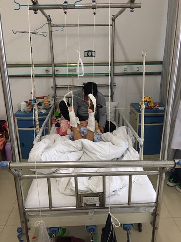 一例小儿股骨干骨折保守治疗分享