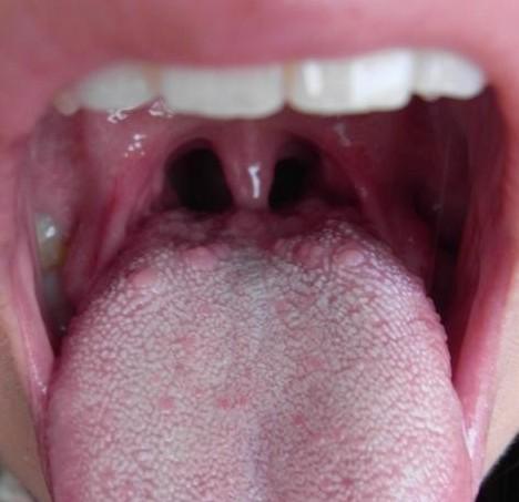 舌头长出肉疙瘩喉咙有异物是什么病怎么治