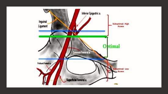 &emsp;&emsp;下图是股动脉最佳,偏低和偏高穿刺位置的示意图