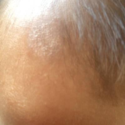 各位宝妈帮我看看我儿子额头那长的那个是什麼癣,好害怕是什麼严重的