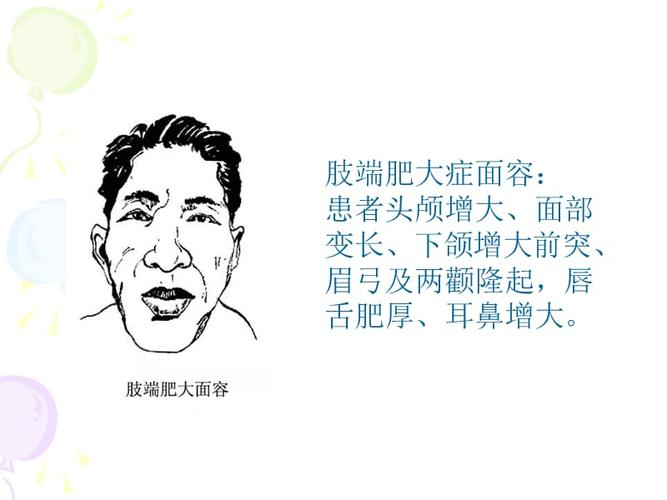 肢端肥大症课件