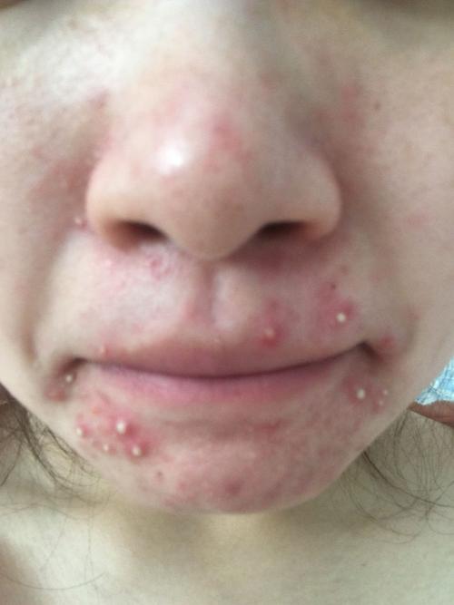 鼻子和嘴巴周边 都经常冒痘痘 有时候还冒得特别厉害,不知道怎会办
