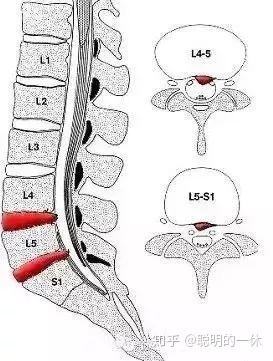 诺鑫说道为什么腰椎间盘都是腰45和腰5骶1突出最常见
