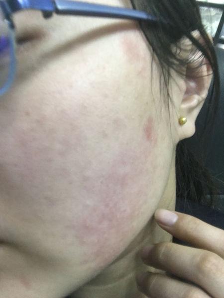 上个星期单位刷墙,我是过敏体质对甲醛过敏,脸上也出了过敏性皮炎,吃