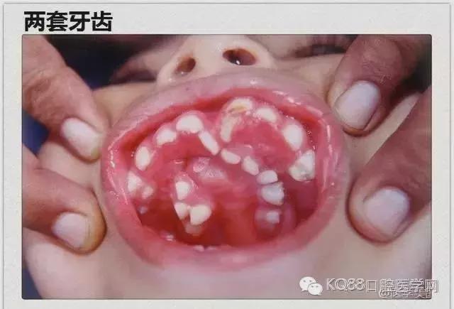 揭秘孩子是如何长出两层牙齿的?