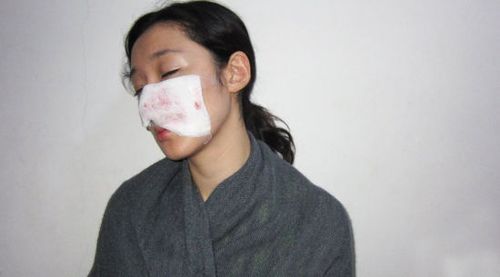 匆匆抬进来一名被咬得血肉模糊的女演员 她叫李依馨,受伤是因为在横店