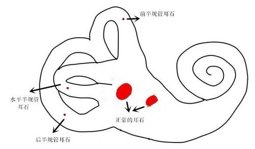 石头"出了轨|天旋地转|耳石症|颈椎病|半规管|头晕|耳朵|熬夜|-健康界