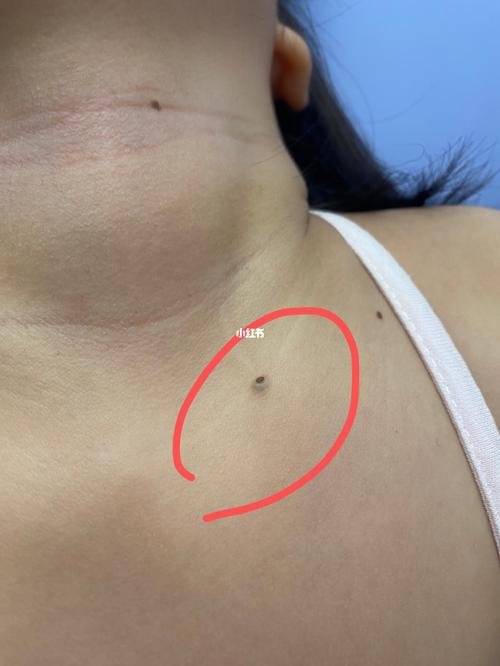 这是传说中的腮裂瘘吗_腮裂囊肿_医疗健康_医疗健康