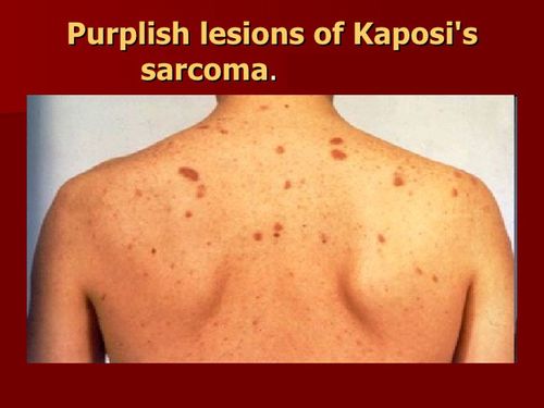 kaposi"s sarcoma