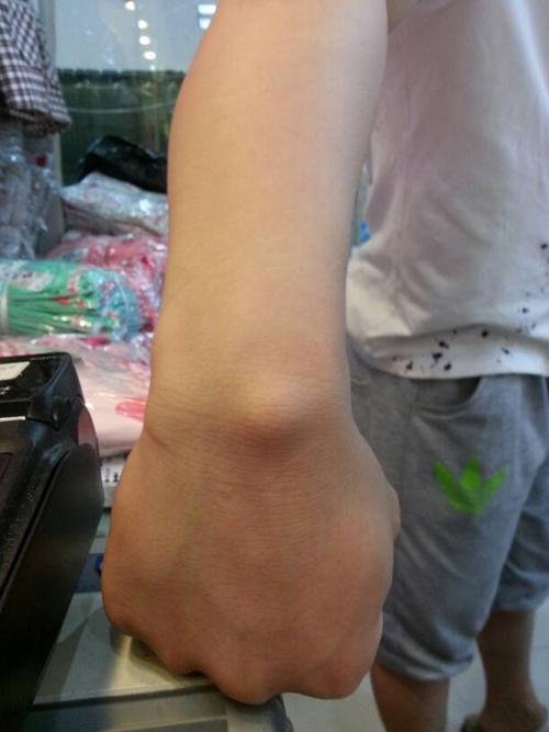请问这是什么情况,朋友手上鼓起一个包半年了?求问医生