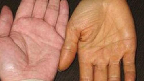 皮肤黄,眼睛黄,乙肝患者身体发黄,多是3个原因引起