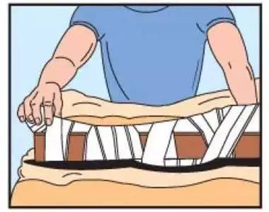 宽绷带缠绕,由远端到近端,大范围缠绕,松紧程度如同包扎扭伤的踝关节