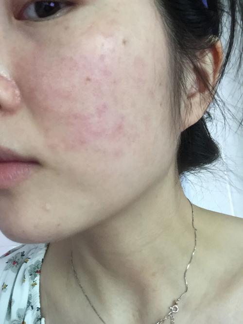 皮肤对面膜过敏了 苗方皮老道擦脸上可以吗