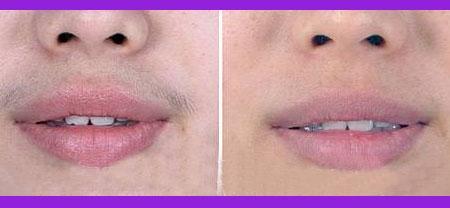 北京激光去唇毛一般需要多少钱呢