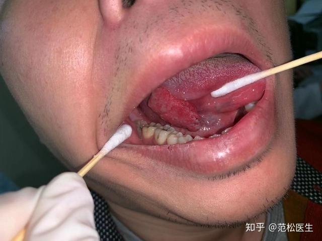 最全总结关于口腔癌防治的科普