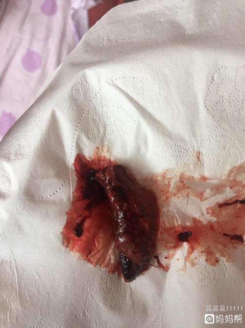 自然流产后流出一块肉疙瘩,这是什么(有图慎入)