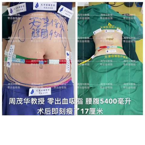 腰腹吸脂超话哇塞,大肚子皮下脂肪非常薄了,不反弹!