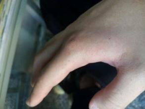 另外,还有热荨麻疹,运动性荨麻疹,震颤性荨麻疹,水源性荨麻疹