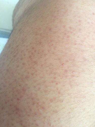 请问这是毛周角质么?怎么治啊?求求好心人啦!怎么能根治啊?