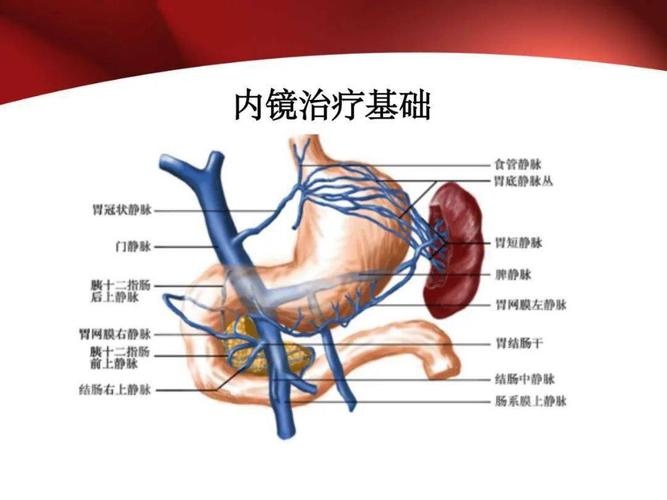 教学ppt | 食管胃静脉曲张内镜治疗策略