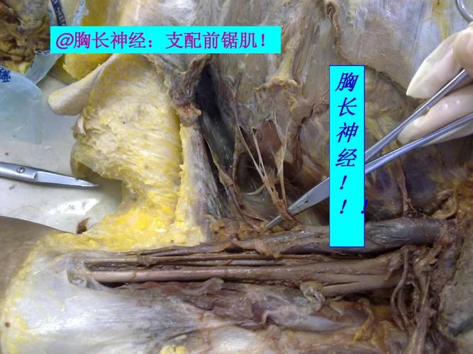 胸长神经:支配前锯肌! 胸 长 神 经 ! !