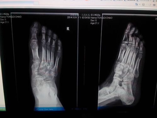 我去年出交通事故脚被摔骨折!现在三月了!