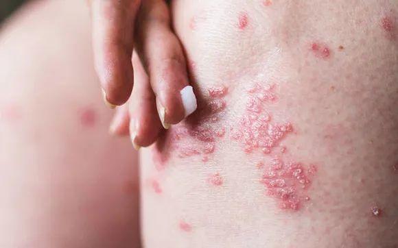 湿疹到底是什么有哪些临床表现怎么治疗