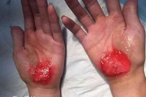 (学生被磨破的手掌,上面涂了红药水.